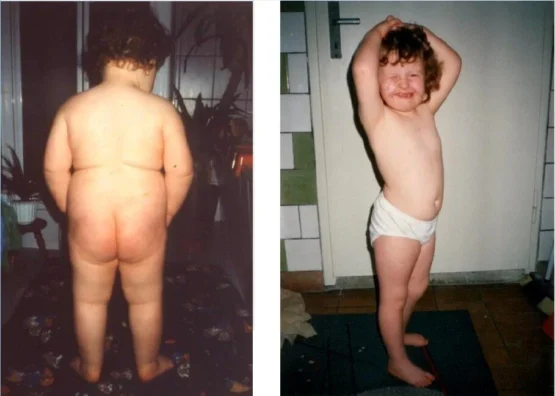 Prader-Willi Syndrom {{brizy_dc_image_alt imageSrc=